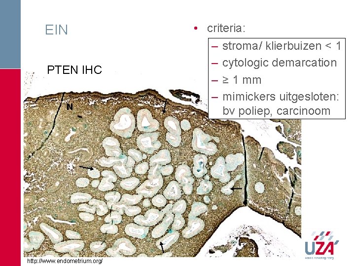 EIN PTEN IHC N http: //www. endometrium. org/ • criteria: – stroma/ klierbuizen < EIN PTEN IHC N http: //www. endometrium. org/ • criteria: – stroma/ klierbuizen <