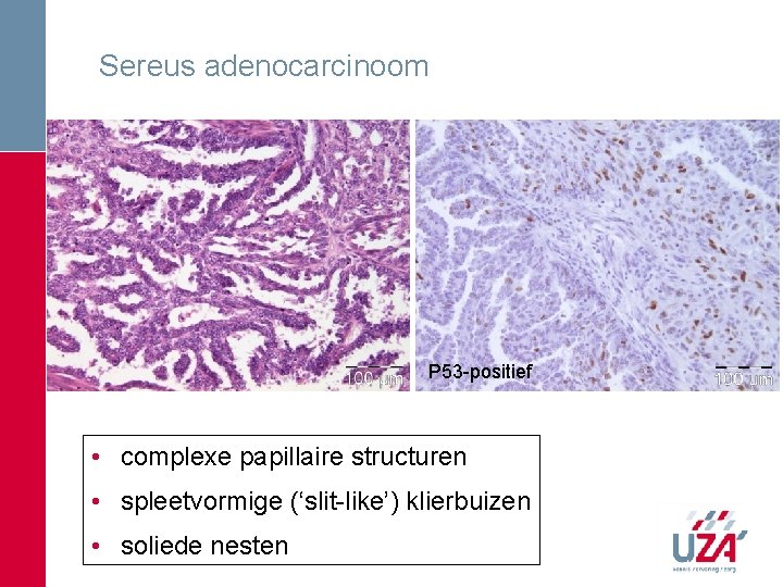 Sereus adenocarcinoom P 53 -positief • complexe papillaire structuren • spleetvormige (‘slit-like’) klierbuizen • Sereus adenocarcinoom P 53 -positief • complexe papillaire structuren • spleetvormige (‘slit-like’) klierbuizen •