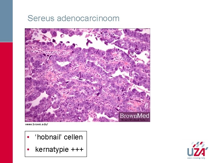 Sereus adenocarcinoom www. brown. edu/ • ‘hobnail’ cellen • kernatypie +++ Sereus adenocarcinoom www. brown. edu/ • ‘hobnail’ cellen • kernatypie +++