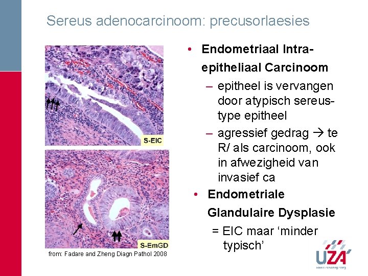 Sereus adenocarcinoom: precusorlaesies from: Fadare and Zheng Diagn Pathol 2008 • Endometriaal Intraepitheliaal Carcinoom Sereus adenocarcinoom: precusorlaesies from: Fadare and Zheng Diagn Pathol 2008 • Endometriaal Intraepitheliaal Carcinoom