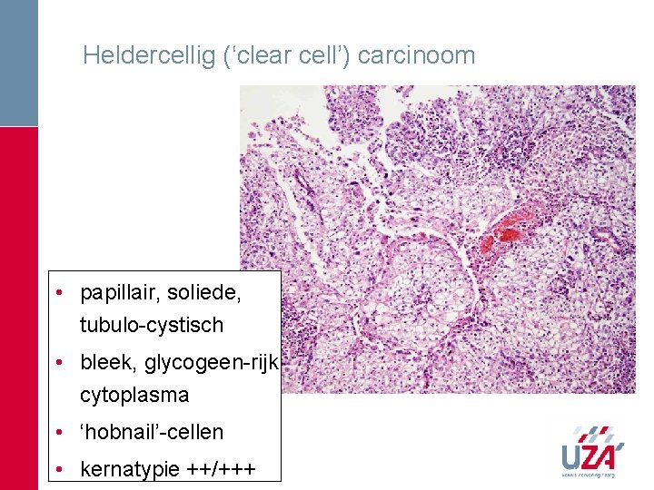 Heldercellig (‘clear cell’) carcinoom • papillair, soliede, tubulo-cystisch • bleek, glycogeen-rijk cytoplasma • ‘hobnail’-cellen Heldercellig (‘clear cell’) carcinoom • papillair, soliede, tubulo-cystisch • bleek, glycogeen-rijk cytoplasma • ‘hobnail’-cellen