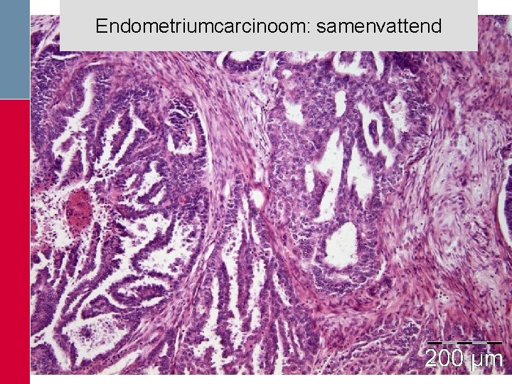 Endometriumcarcinoom: samenvattend Endometriumcarcinoom: samenvattend