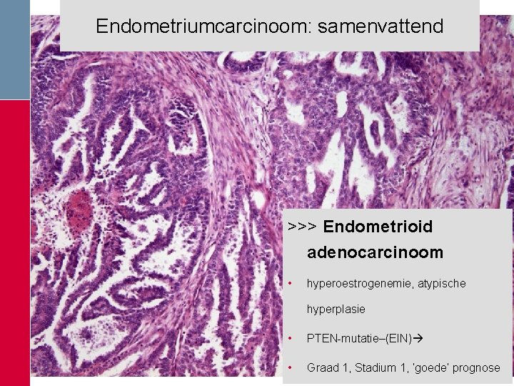 Endometriumcarcinoom: samenvattend >>> Endometrioid adenocarcinoom • hyperoestrogenemie, atypische hyperplasie • PTEN-mutatie–(EIN) • Graad 1, Endometriumcarcinoom: samenvattend >>> Endometrioid adenocarcinoom • hyperoestrogenemie, atypische hyperplasie • PTEN-mutatie–(EIN) • Graad 1,