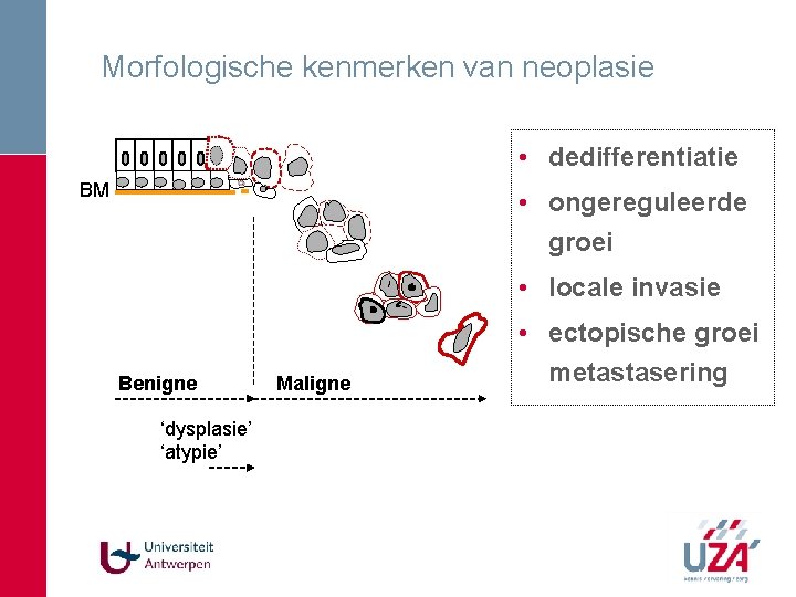 Morfologische kenmerken van neoplasie • dedifferentiatie BM • ongereguleerde groei • locale invasie Benigne Morfologische kenmerken van neoplasie • dedifferentiatie BM • ongereguleerde groei • locale invasie Benigne