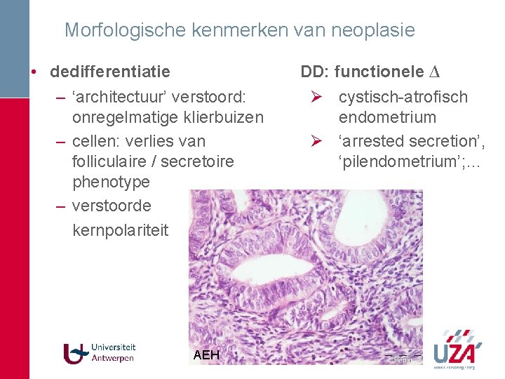Morfologische kenmerken van neoplasie • dedifferentiatie – ‘architectuur’ verstoord: onregelmatige klierbuizen – cellen: verlies Morfologische kenmerken van neoplasie • dedifferentiatie – ‘architectuur’ verstoord: onregelmatige klierbuizen – cellen: verlies