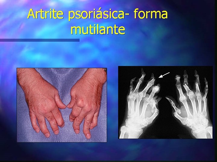 Artrite psoriásica- forma mutilante 