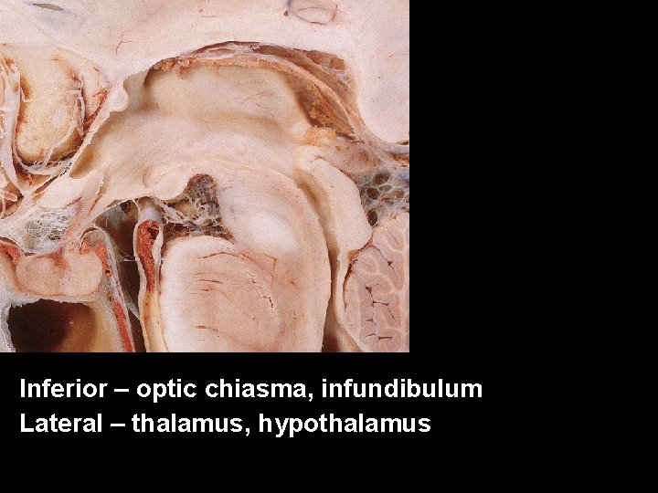 Inferior – optic chiasma, infundibulum Lateral – thalamus, hypothalamus 