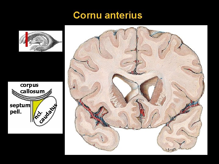 Cornu anterius nc ca l. ud at septum pell. us corpus callosum 