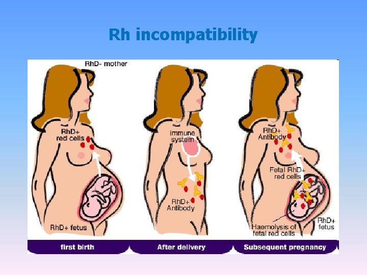 Rh incompatibility Rh incompatibility