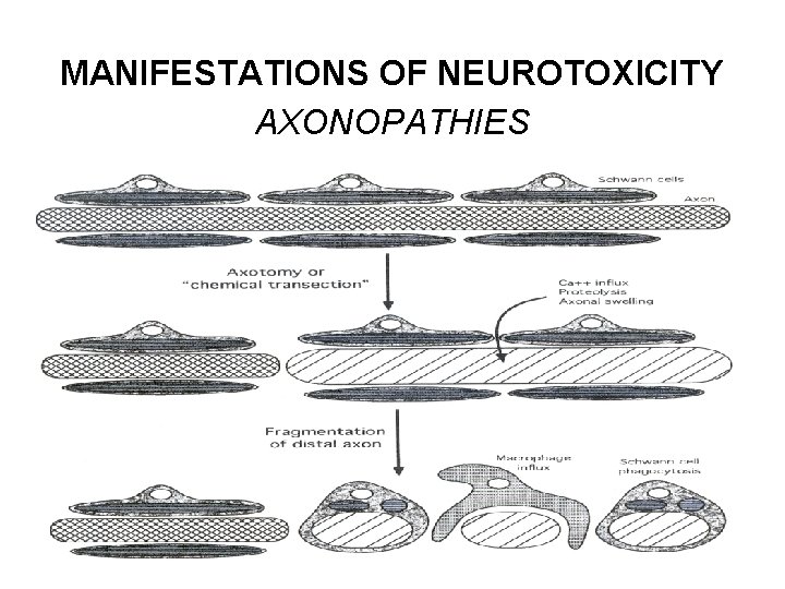 MANIFESTATIONS OF NEUROTOXICITY AXONOPATHIES 