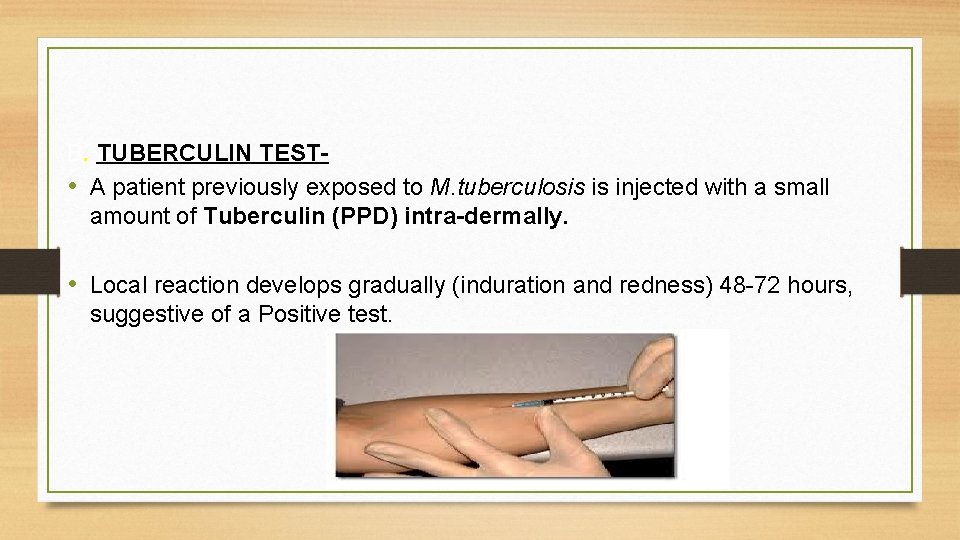 B. TUBERCULIN TEST • A patient previously exposed to M. tuberculosis is injected with