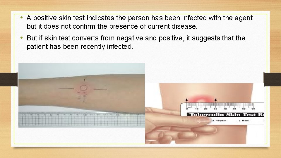  • A positive skin test indicates the person has been infected with the