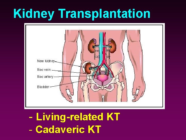 Kidney Transplantation - Living-related KT - Cadaveric KT 