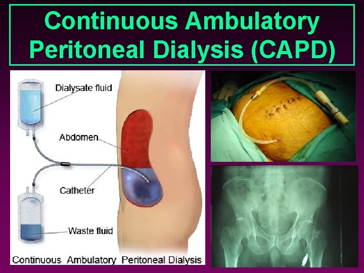 Continuous Ambulatory Peritoneal Dialysis (CAPD) 