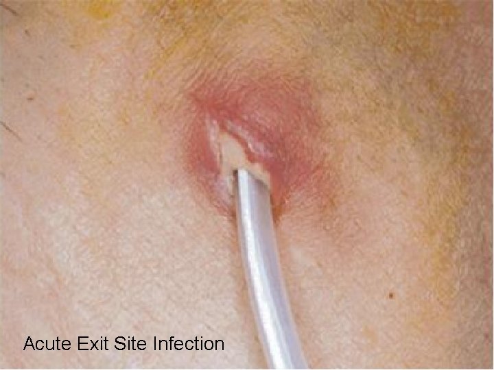 Complications Infection 1. Exit site infection & Tunnel infection - common cause: staph. aureus