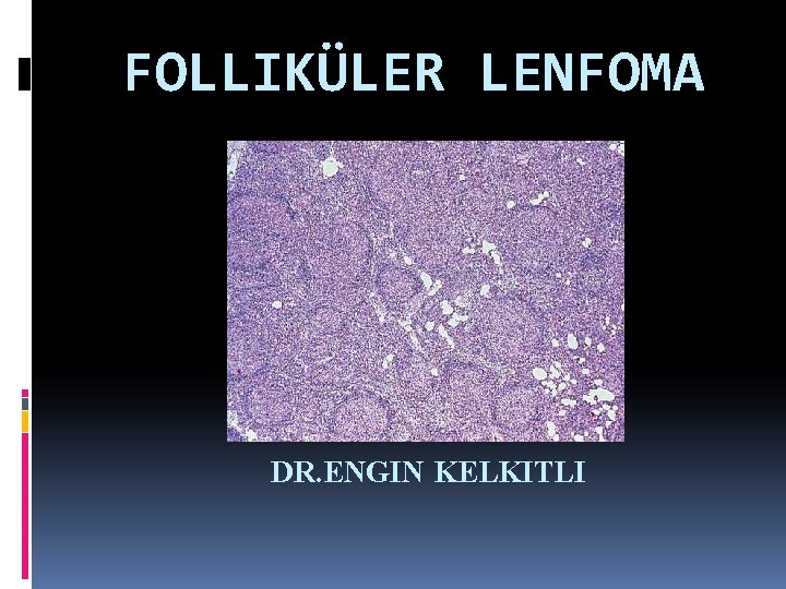 FOLLIKÜLER LENFOMA DR. ENGIN KELKITLI 
