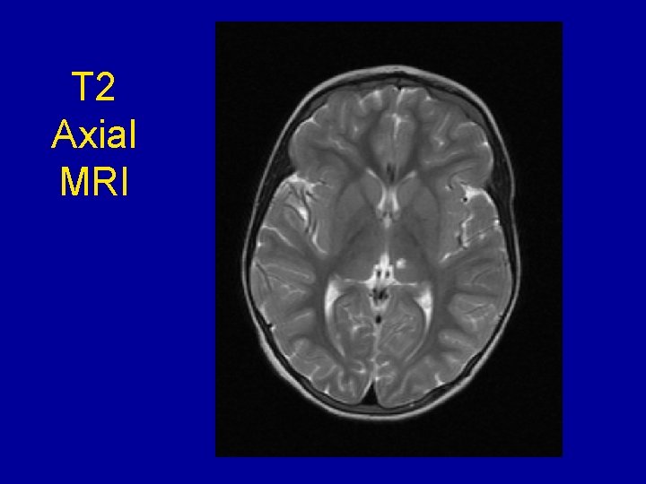 T 2 Axial MRI 