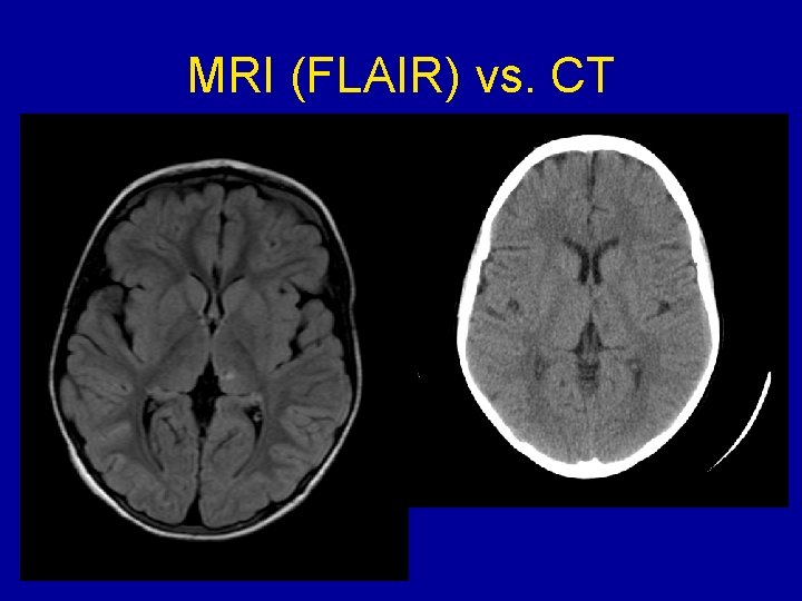 MRI (FLAIR) vs. CT 