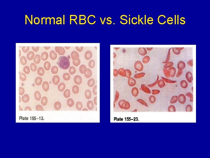 Normal RBC vs. Sickle Cells 