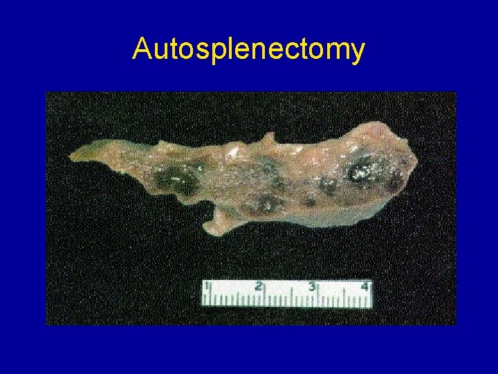 Autosplenectomy 