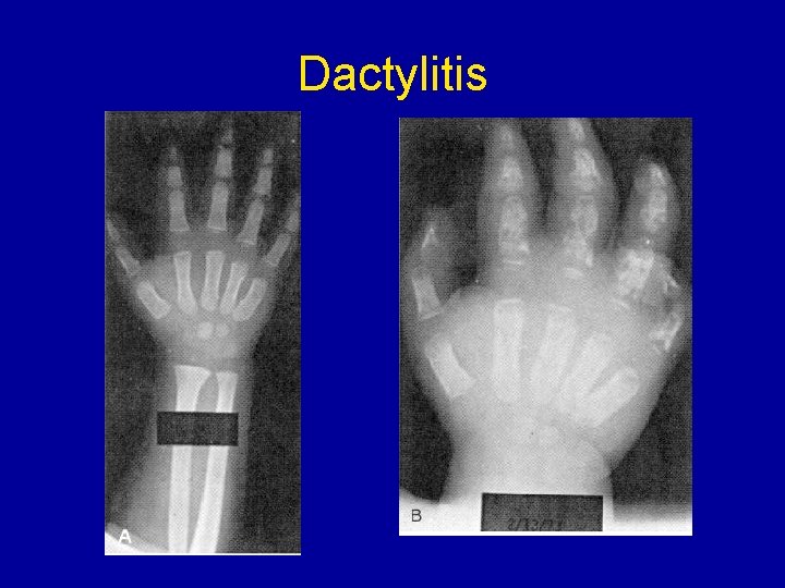 Dactylitis 