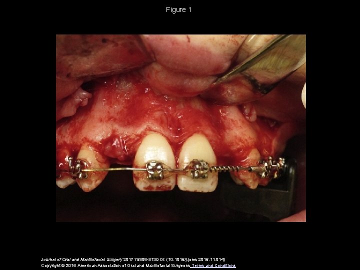 Figure 1 Journal of Oral and Maxillofacial Surgery 2017 75509 -513 DOI: (10. 1016/j.