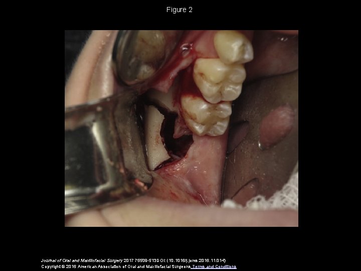 Figure 2 Journal of Oral and Maxillofacial Surgery 2017 75509 -513 DOI: (10. 1016/j.