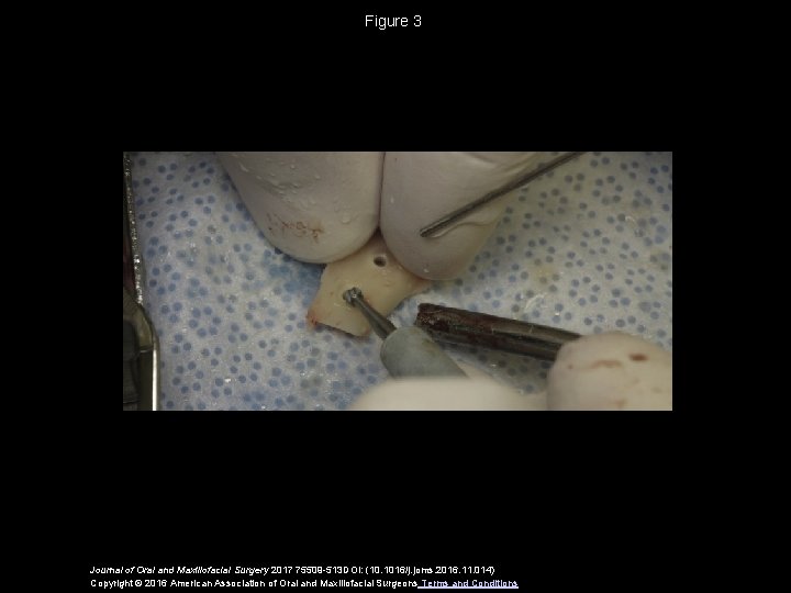 Figure 3 Journal of Oral and Maxillofacial Surgery 2017 75509 -513 DOI: (10. 1016/j.