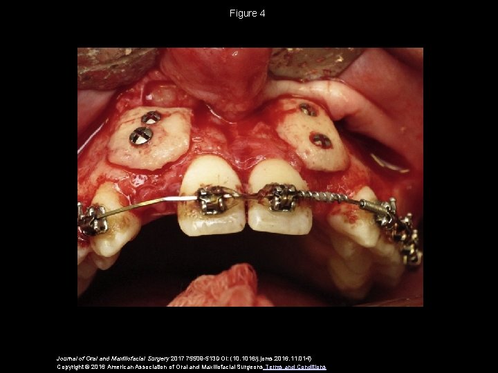 Figure 4 Journal of Oral and Maxillofacial Surgery 2017 75509 -513 DOI: (10. 1016/j.