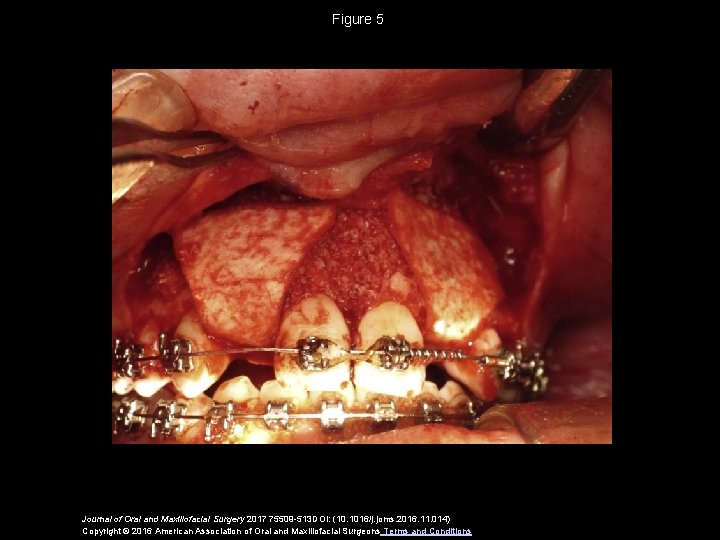 Figure 5 Journal of Oral and Maxillofacial Surgery 2017 75509 -513 DOI: (10. 1016/j.
