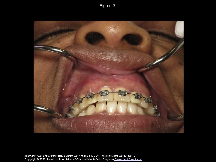 Figure 6 Journal of Oral and Maxillofacial Surgery 2017 75509 -513 DOI: (10. 1016/j.