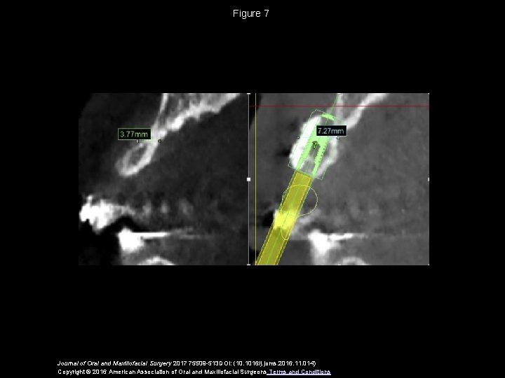 Figure 7 Journal of Oral and Maxillofacial Surgery 2017 75509 -513 DOI: (10. 1016/j.