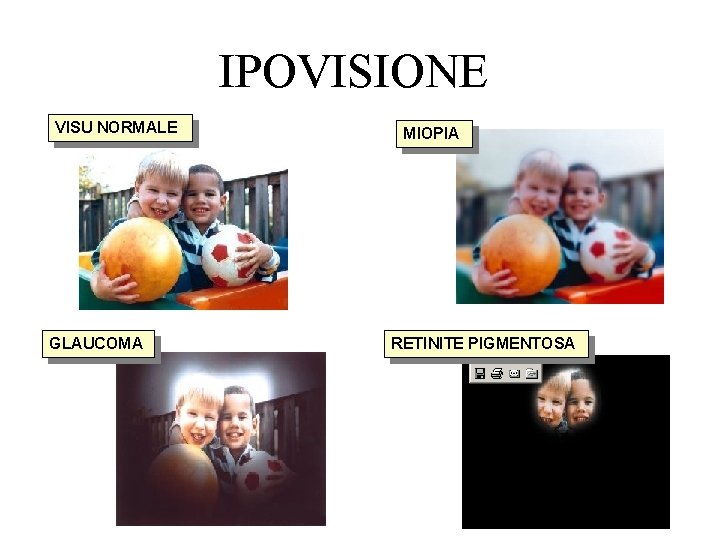 IPOVISIONE VISU NORMALE GLAUCOMA MIOPIA RETINITE PIGMENTOSA IPOVISIONE VISU NORMALE GLAUCOMA MIOPIA RETINITE PIGMENTOSA