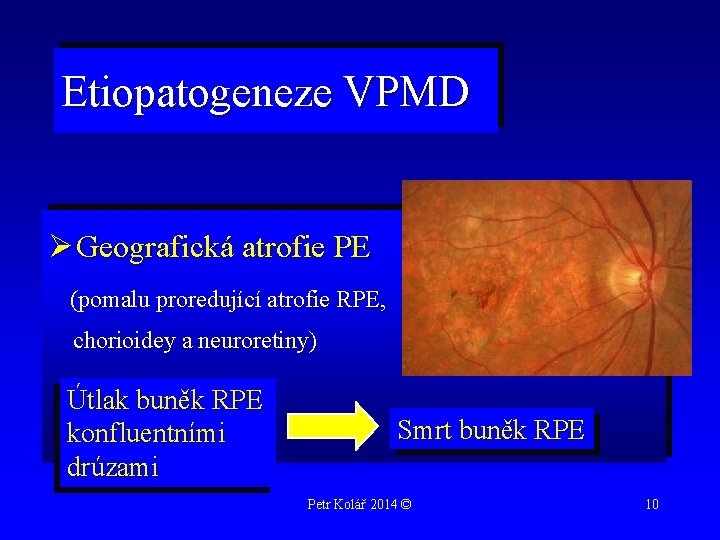 Etiopatogeneze VPMD Ø Geografická atrofie PE (pomalu proredující atrofie RPE, chorioidey a neuroretiny) Útlak