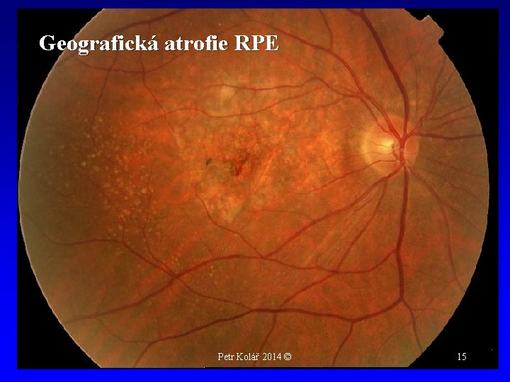 Geografická atrofie RPE Petr Kolář 2014 © 15 