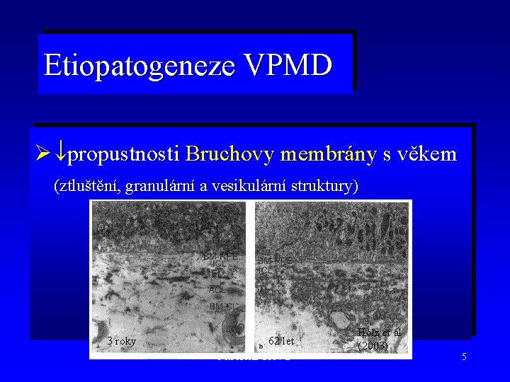 Etiopatogeneze VPMD Ø propustnosti Bruchovy membrány s věkem (ztluštění, granulární a vesikulární struktury) 3