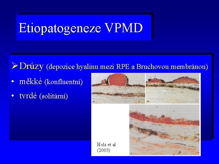 Etiopatogeneze VPMD Ø Drúzy (depozice hyalinu mezi RPE a Bruchovou membránou) • měkké (konfluentní)