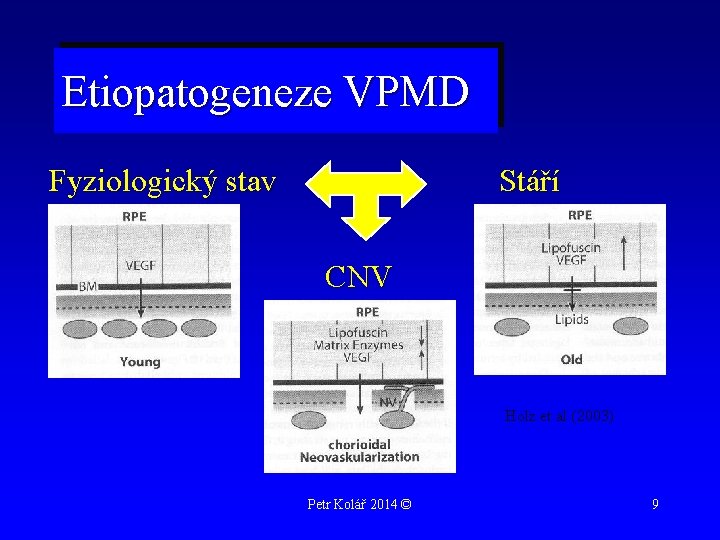 Etiopatogeneze VPMD Fyziologický stav Stáří CNV Holz et al (2003) Petr Kolář 2014 ©