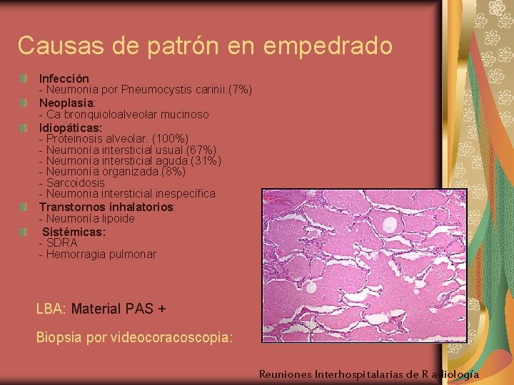 Causas de patrón en empedrado Infección - Neumonia por Pneumocystis carinii. (7%) Neoplasia: -