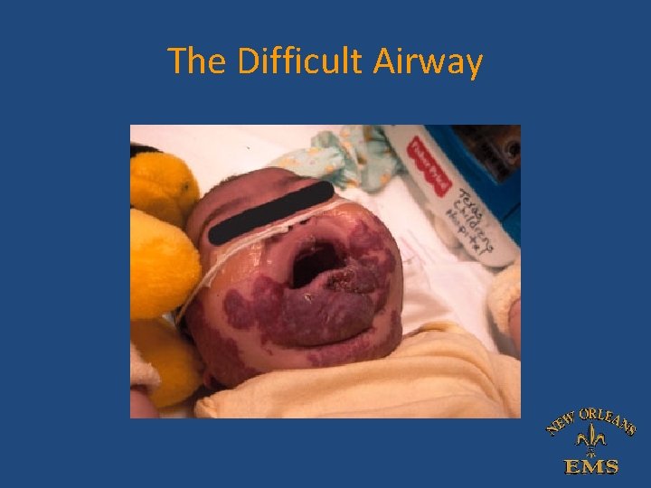 The Difficult Airway The Difficult Airway