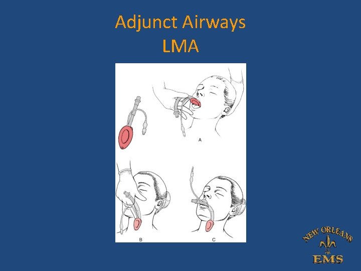 Adjunct Airways LMA Adjunct Airways LMA