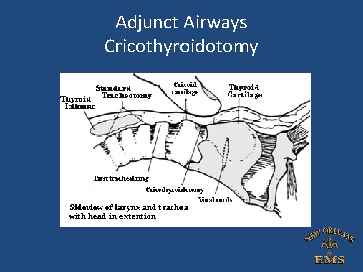 Adjunct Airways Cricothyroidotomy Adjunct Airways Cricothyroidotomy