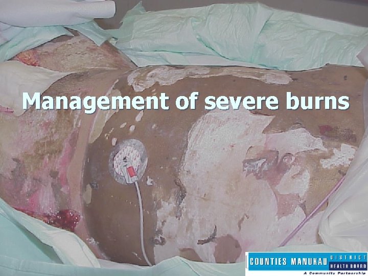 Management of severe burns 