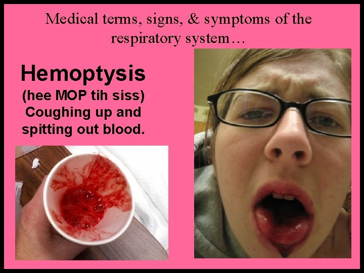 Medical terms, signs, & symptoms of the respiratory system… Hemoptysis (hee MOP tih siss)