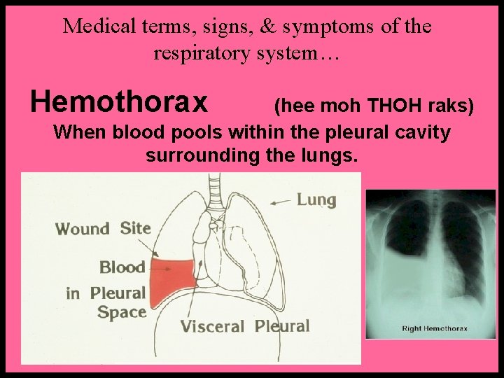 Medical terms, signs, & symptoms of the respiratory system… Hemothorax (hee moh THOH raks)