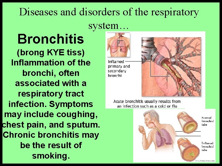 Diseases and disorders of the respiratory system… Bronchitis (brong KYE tiss) Inflammation of the