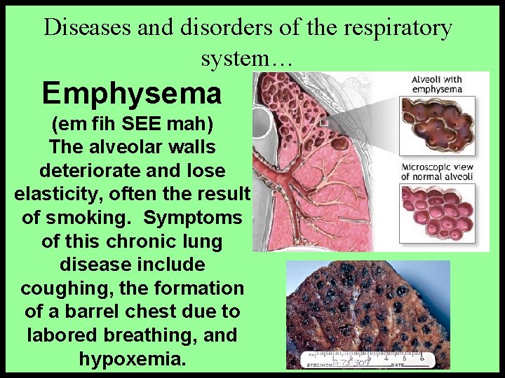 Diseases and disorders of the respiratory system… Emphysema (em fih SEE mah) The alveolar