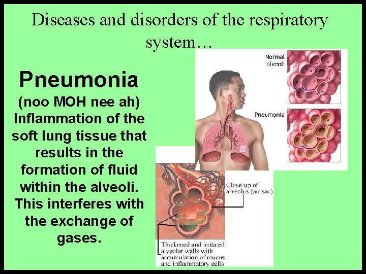 Diseases and disorders of the respiratory system… Pneumonia (noo MOH nee ah) Inflammation of