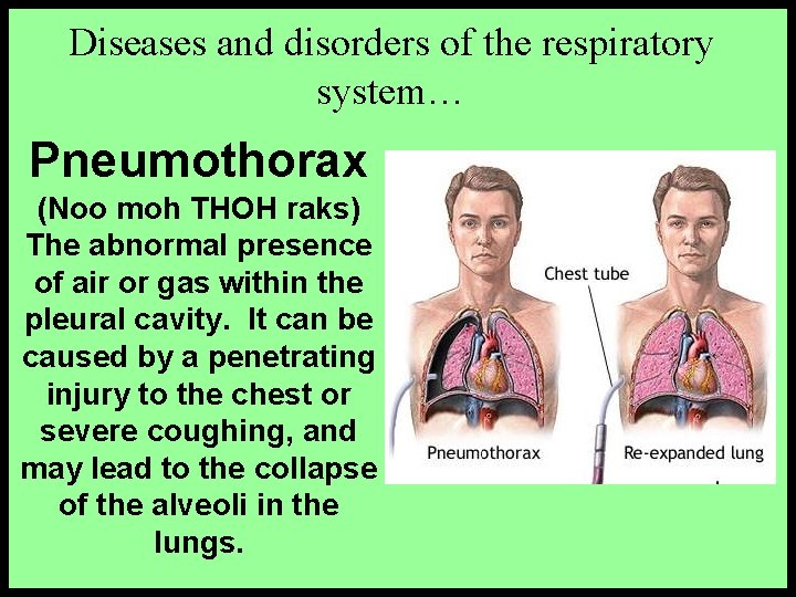 Diseases and disorders of the respiratory system… Pneumothorax (Noo moh THOH raks) The abnormal