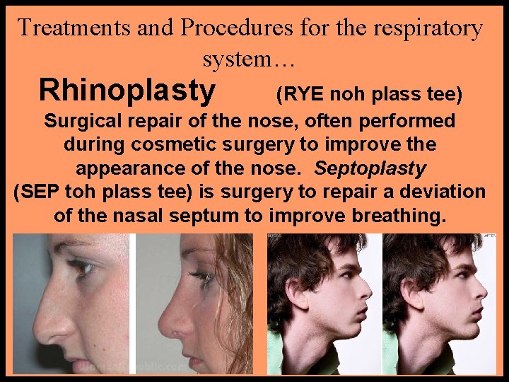 Treatments and Procedures for the respiratory system… Rhinoplasty (RYE noh plass tee) Surgical repair